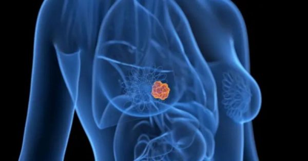 Científicos desarrollan una IA capaz de detectar cáncer de mama cinco años antes de que aparezca