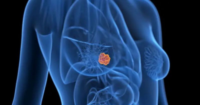 Científicos desarrollan una IA capaz de detectar cáncer de mama cinco años antes de que aparezca