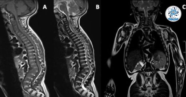 ¿Qué es el Síndrome de Morquio y cuáles son los preocupantes síntomas?