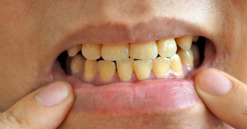 Ni vinagre ni bicarbonato: el método definitivo para erradicar el sarro de los dientes y no tener mal aliento