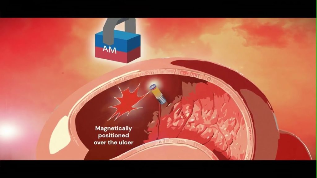 Investigadores suizos desarrollan la primera bioimpresora magnética ingerible del mundo para curar úlceras desde el interior del cuerpo