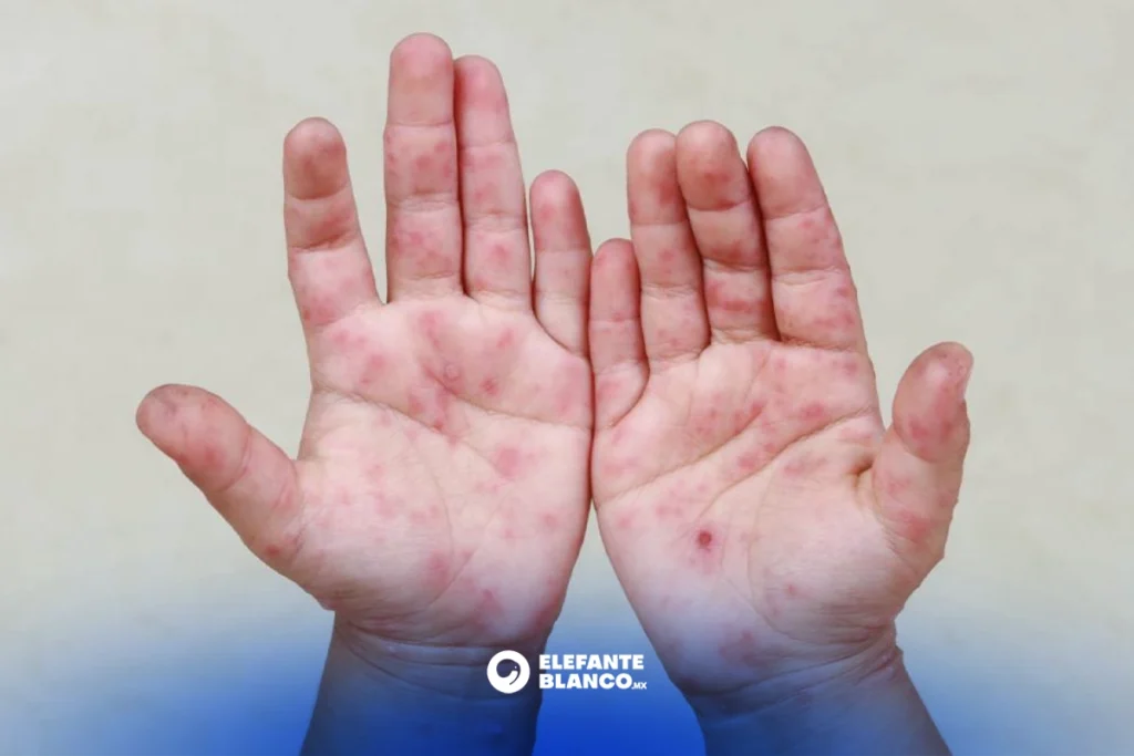 Coxsackie obliga al cierre de kínder en Tampico - Elefante Blanco