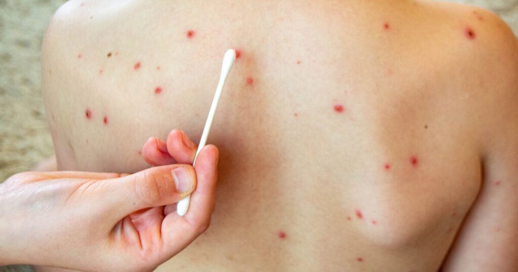 Con esquema completo de vacunación, no es necesario el uso de cubrebocas contra sarampión