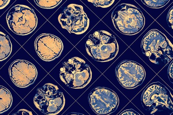 La extraña relación entre exponernos a la luz del día y la probabilidad de desarrollar demencia