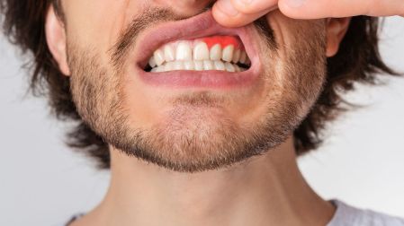 ¿Tus dientes se ven más largos? Puede tratarse de recesión gingival - Ilustración 1