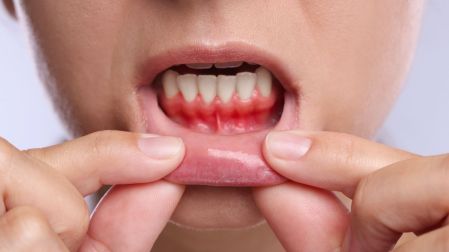 ¿Tus dientes se ven más largos? Puede tratarse de recesión gingival - Ilustración 2