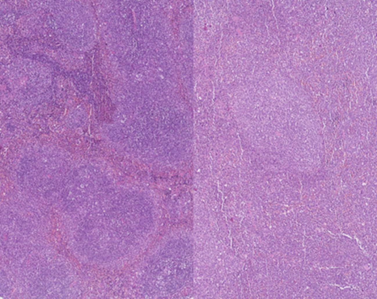 Estos seis genes podrían predecir la supervivencia en la leucemia - Ilustración 1